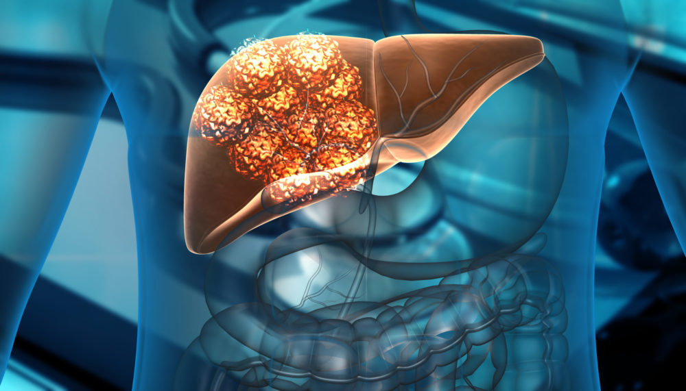 Alertan que los casos de cáncer de hígado se duplicarán en 2050