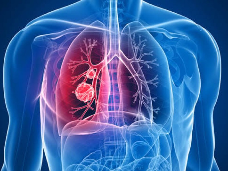 El cáncer de pulmón podría provocar la muerte de 160.000 latinoamericanos en 10 años